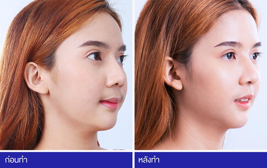 บริการตัดไขมันกระพุ้งแก้ม Yanhee Hospital - 2