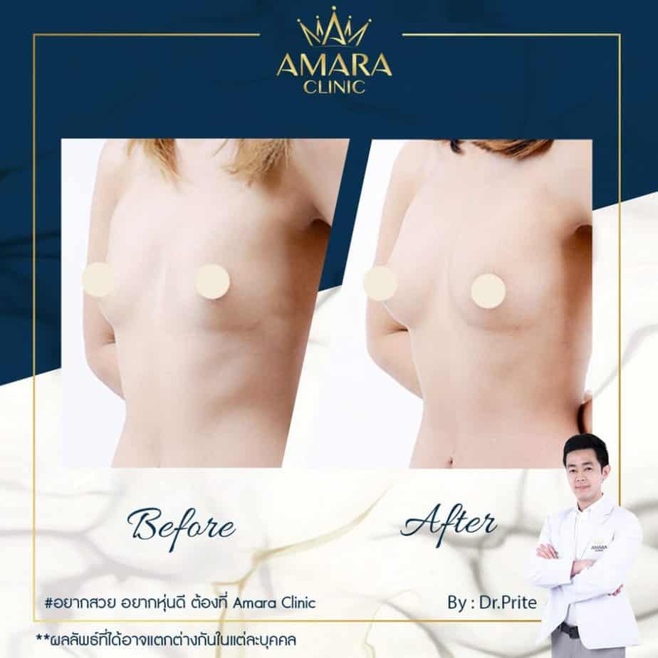Amara Clinic คลินิกฉีดไขมันหน้าอก - 2