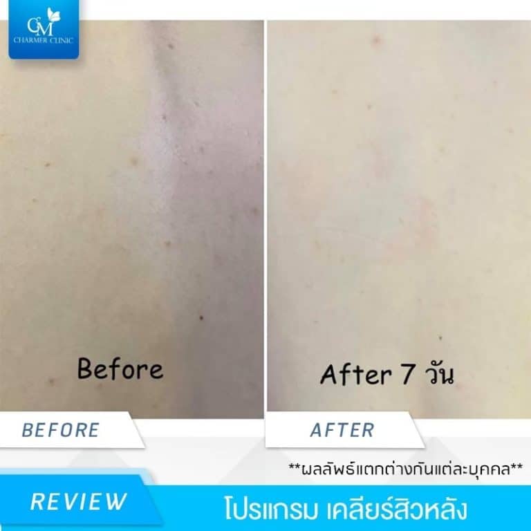 Charmer Clinic รักษาสิวที่หลัง - 2