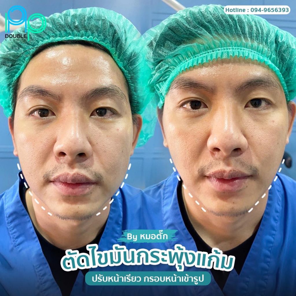 Double P Clinic บริการตัดไขมันกระพุ้งแก้ม - 2