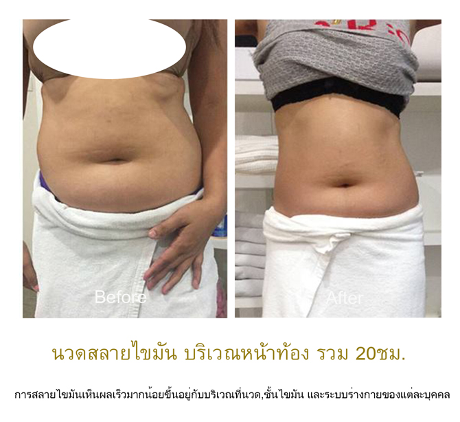 10 อันดับ นวดสลายไขมัน ที่ไหนดี กระชับสัดส่วน เห็นผลได้จริงปี 11 Elegance Slim Up บริการนวดสลายไขมัน - 2