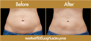 10 อันดับ นวดสลายไขมัน ที่ไหนดี กระชับสัดส่วน เห็นผลได้จริงปี 16 F Clinic คลินิกนวดสลายไขมัน - 2