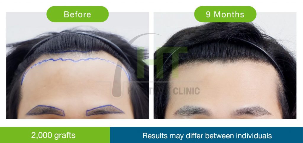 Hairtran Clinic บริการปลูกคิ้วถาวร - 2