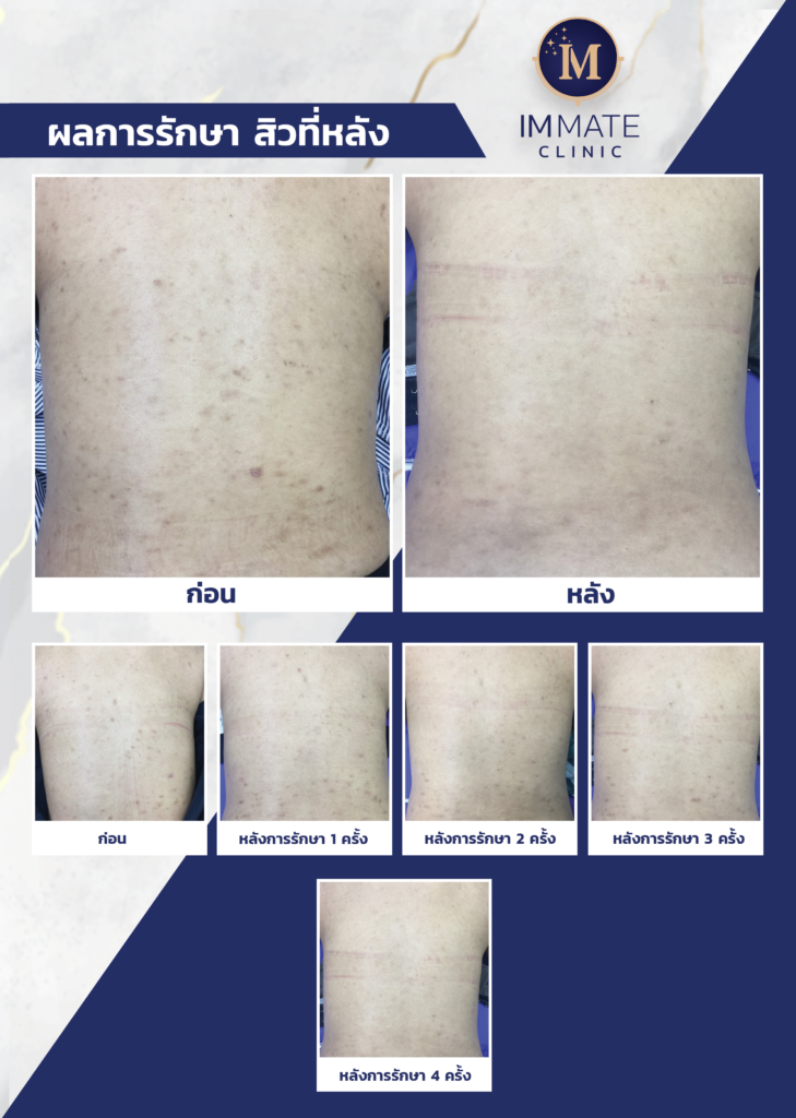 Immate Clinic รักษาสิวที่หลังที่ดีที่สุด - 2