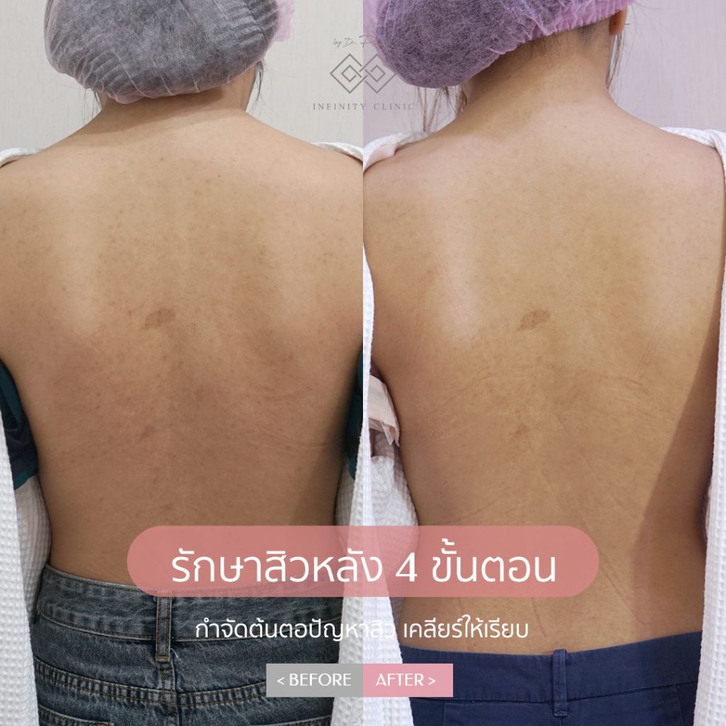 Infinity Clinic by Dr. Palm รักษาสิวที่หลัง - 2