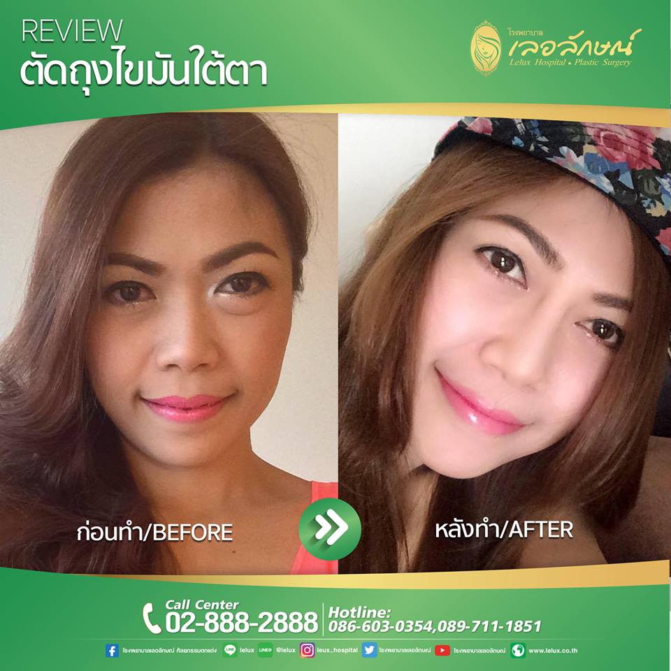 LELUX Hospital ผ่าตัดถุงใต้ตา - 2