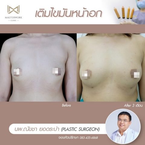 Masterwork Clinic บริการฉีดไขมันหน้าอก - 2