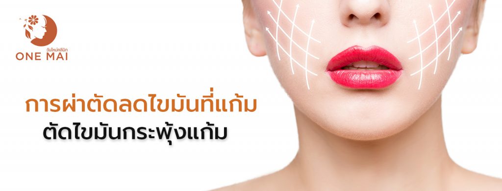 One Mai Clinic บริการตัดไขมันกระพุ้งแก้ม - 1