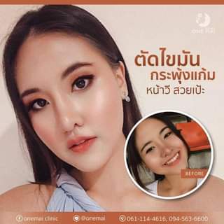 One Mai Clinic บริการตัดไขมันกระพุ้งแก้ม - 2
