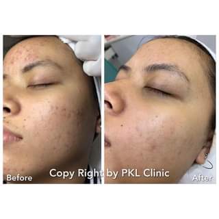 PKL Clinic คลินิกกดสิว - 2