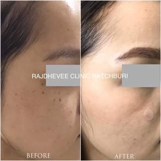 Rajdhevee Clinic บริการเลเซอร์สิวหิน - 2