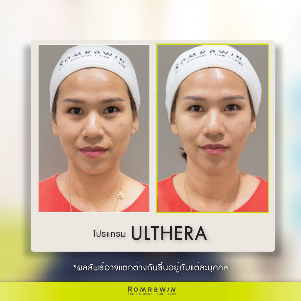 Romrawin Clinic โปรแกรมทำ Ulthera -2