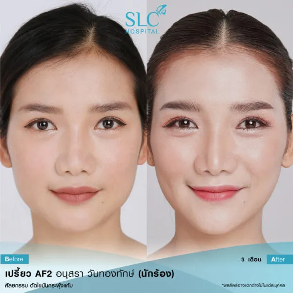 SLC Hospital บริการตัดไขมันกระพุ้งแก้ม - 2