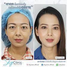 Sky Clinic บริการผ่าตัดถุงใต้ตา - 2