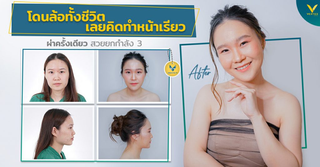 Vertex Clinic บริการตัดไขมันกระพุ้งแก้ม - 2