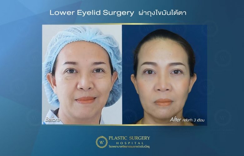 W Plastic Surgery Hospital ผ่าตัดถุงใต้ตา - 2