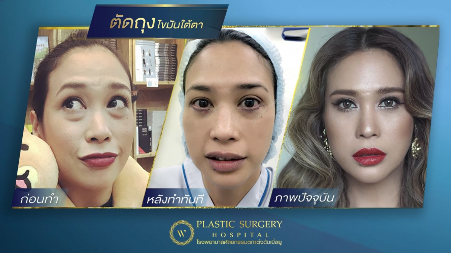 W Plastic Surgery Hospital ผ่าตัดถุงใต้ตา - 1