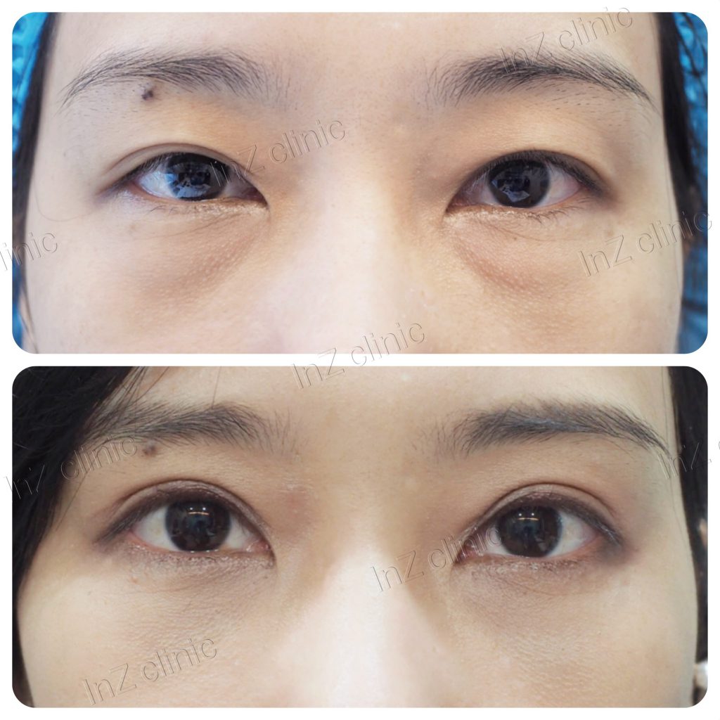 inZ Skin & Surgery Clinic คลินิกผ่าตัดถุงใต้ตา - 2