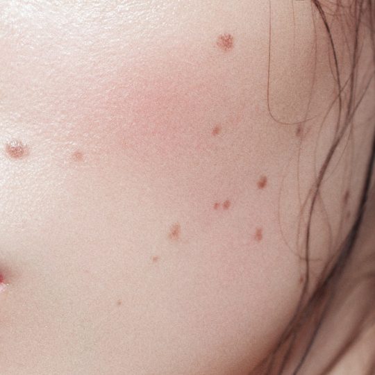 จี้ไฝ ที่ไหนดี - 1