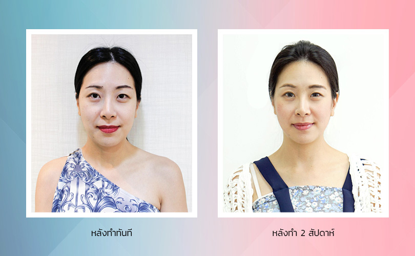 ราชเทวีคลินิก บริการหน้าเรียว V-shape - 2