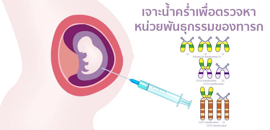 Bangkok Hospital Ratchasima บริการตรวจดาวน์ซินโดรม - 2