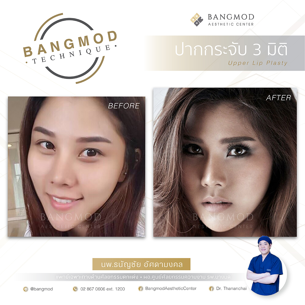 Bangmod Aesthetic Center บริการทำปากกระจับ - 2