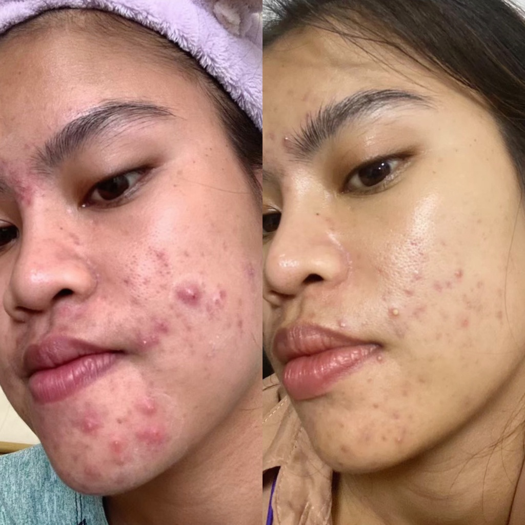 Blossom Clinic คลินิกเลเซอร์สิวอุดตัน - 2