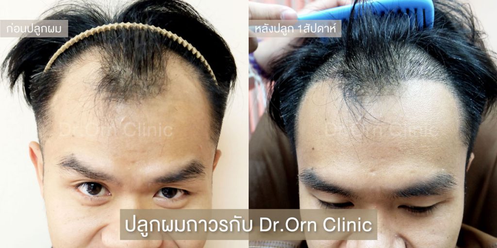 Dr. Orn Medical Hair Clinic คลินิกปลูกผม - 2