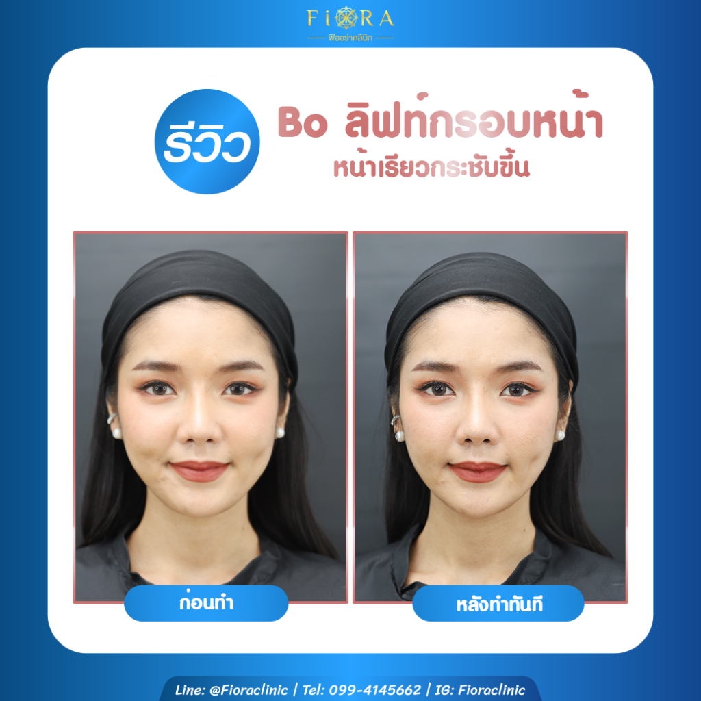 FIORA Clinic บริการหน้าเรียว V-shape - 2