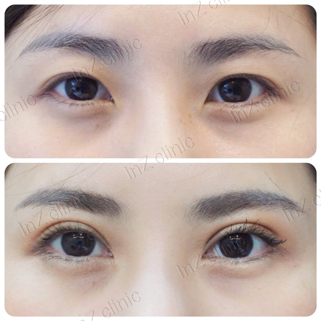 InZ Clinic คลินิกทำตา 2 ชั้น - 2