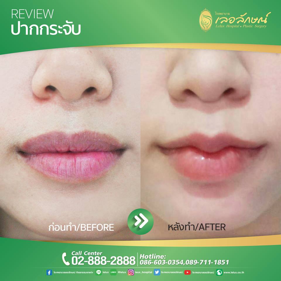 Lelux Hospital บริการทำปากกระจับ - 2