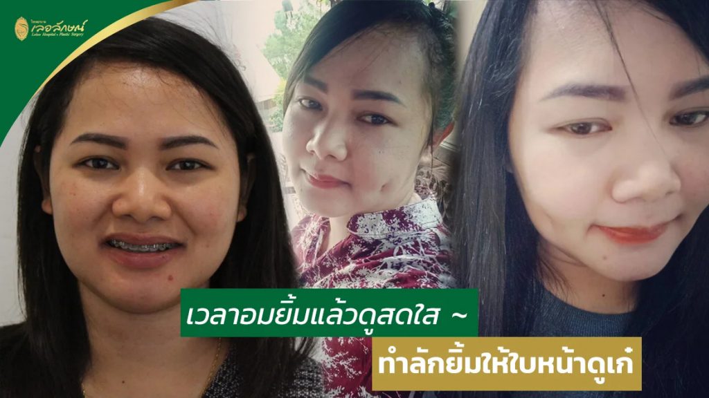 Lelux Hospital ศัลยกรรมทำลักยิ้ม - 2