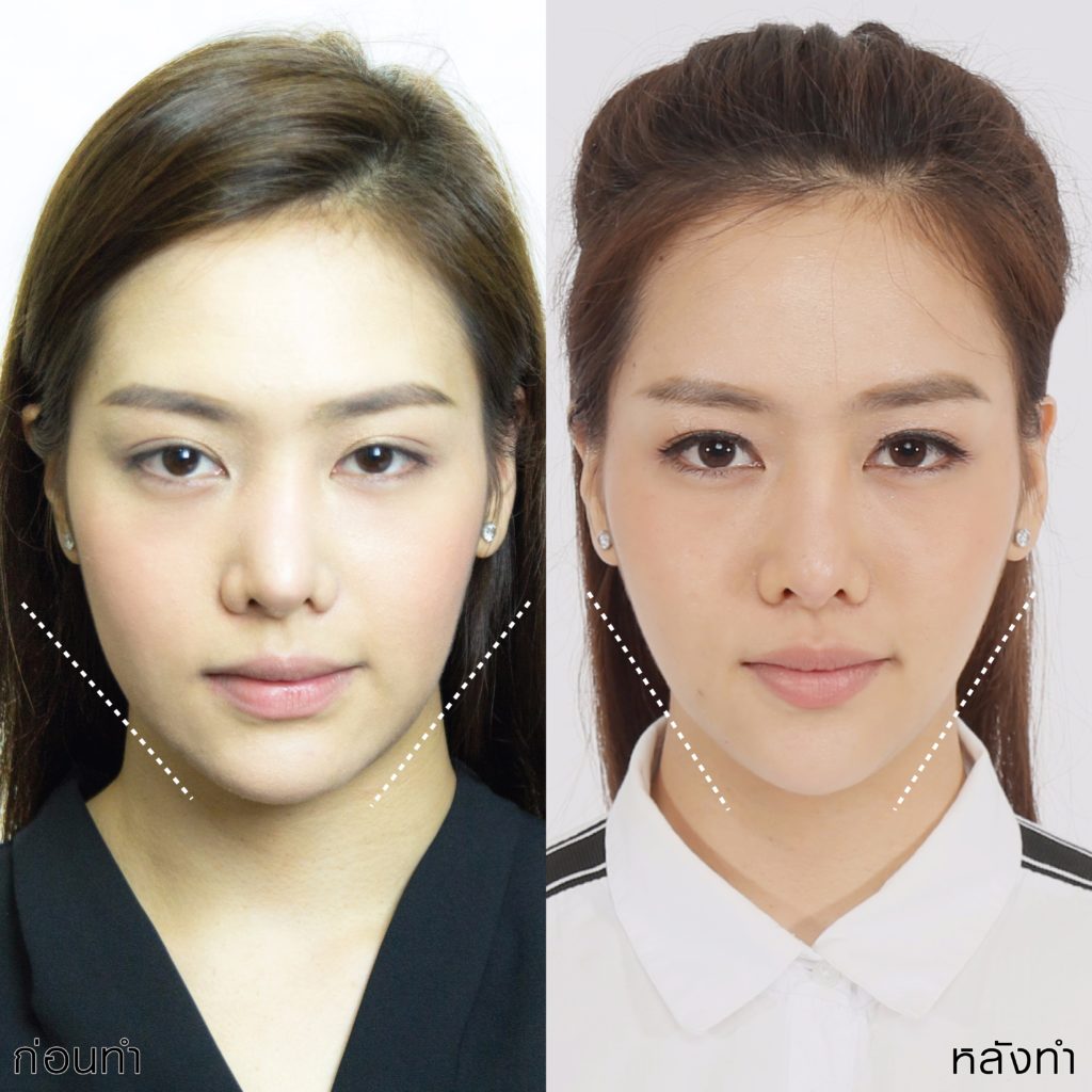 MEKO Clinic คลินิกหน้าเรียว V-shape - 2
