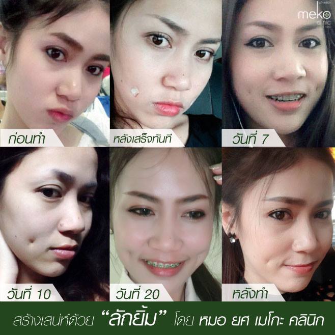 Meko Clinic คลินิกทำลักยิ้ม - 2
