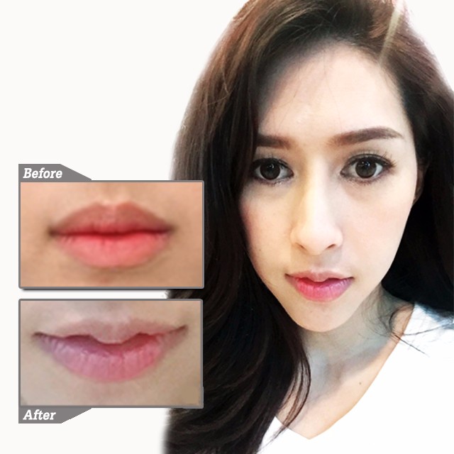Meko Clinic บริการทำปากกระจับ - 2