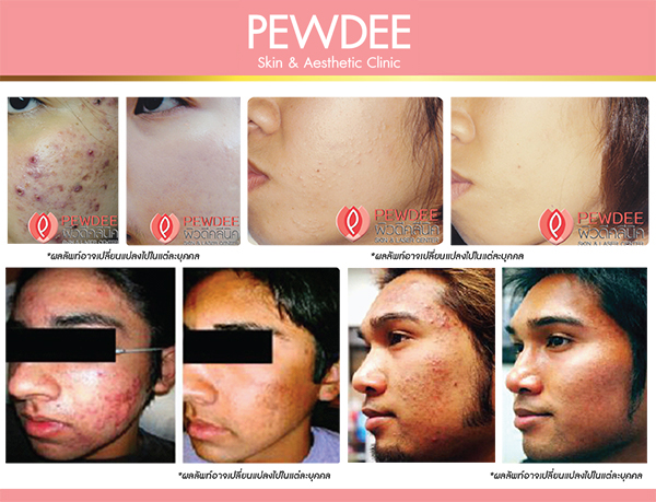 PEWDEE Clinic คลินิกเลเซอร์สิวอุดตัน - 2