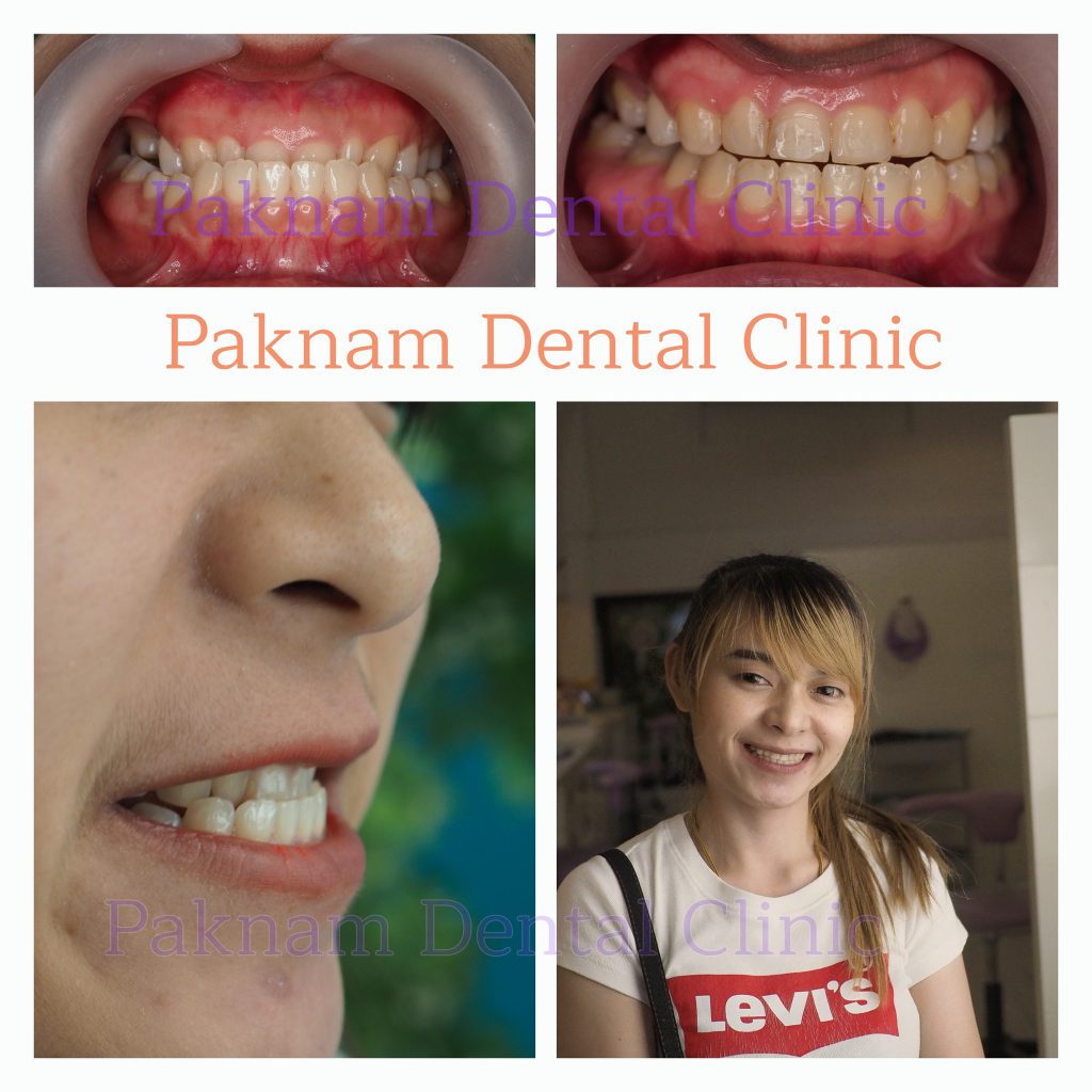 Paknam Dental Clinic บริการทำวีเนียร์ - 2