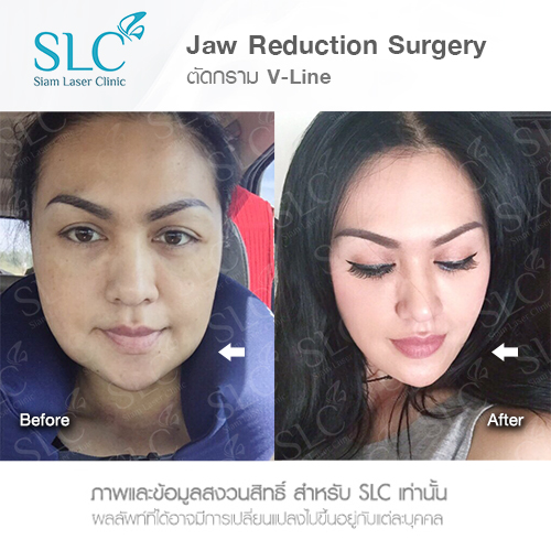 SLC Clinic บริการหน้าเรียว V-shape - 2