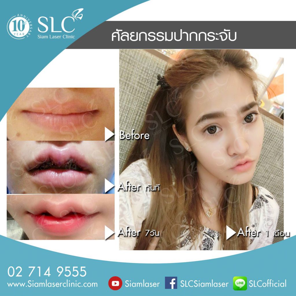 SLC Clinic ศัลยกรรมทำปากกระจับ - 2