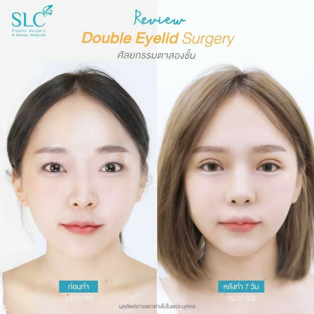 SLC Plastic Surgery & Dental Hospital ศัลยกรรมทำตา 2 ชั้น - 2