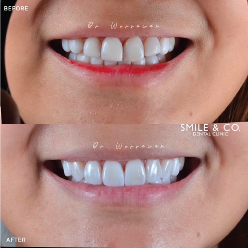 Smile & Co. Dental Clinic คลินิกทำวีเนียร์ - 2