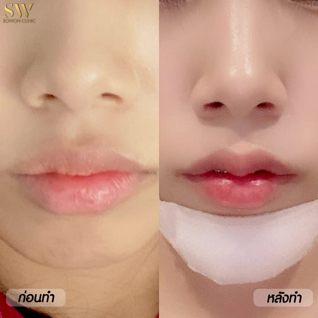 Sowon Clinic คลินิกทำปากกระจับ - 2