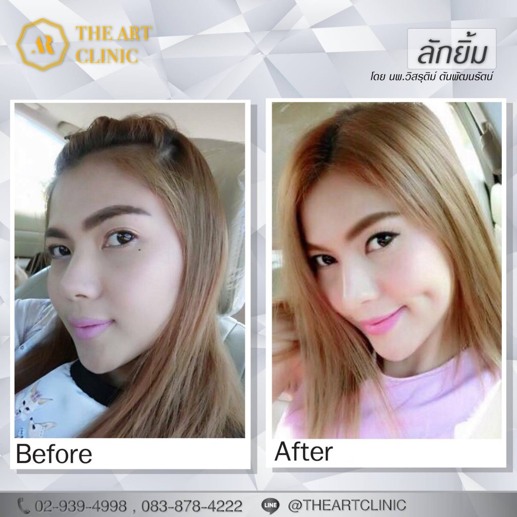 The Art Clinic ศัลยกรรมทำลักยิ้ม - 2