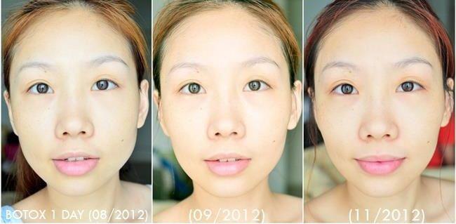 The Klinique บริการหน้าเรียว V-shape - 2