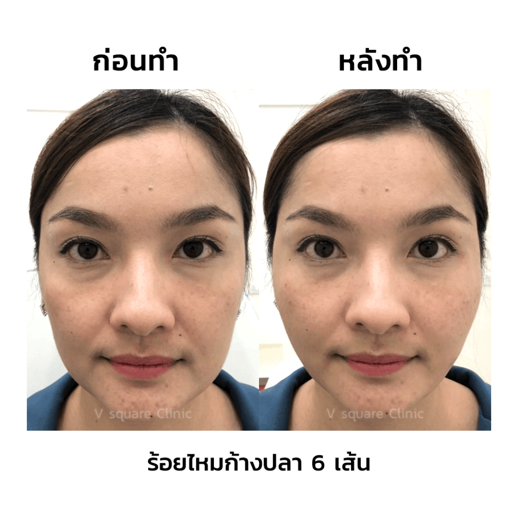 V Square Clinic คลินิกหน้าเรียว V-shape - 2