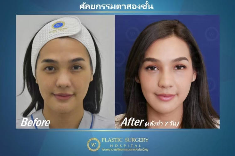 W Plastic Surgery Hospital บริการทำตา 2 ชั้น - 2