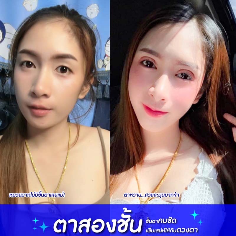 โรงพยาบาลยันฮี บริการทำตา 2 ชั้น - 2