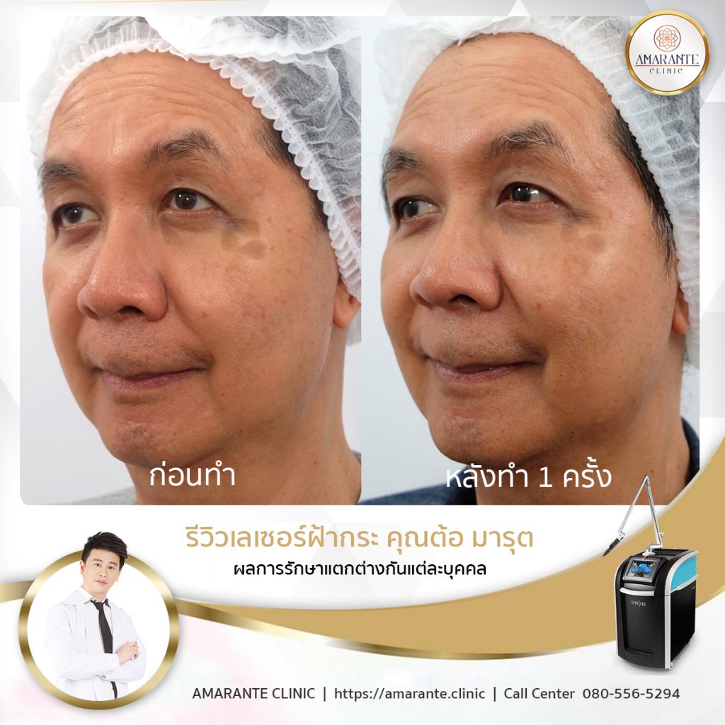 Amarante Clinic เลเซอร์ฝ้ากระ - 2