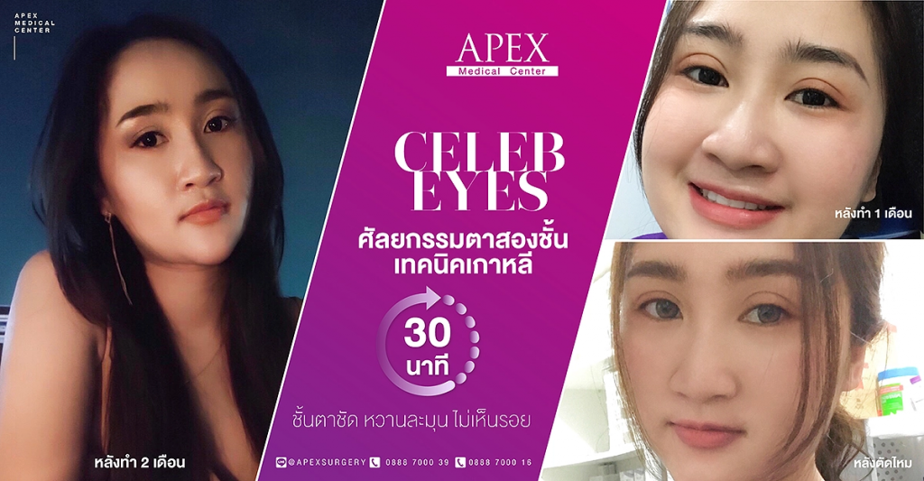 Apex Medical Center บริการทำตาสองชั้น สไตล์เกาหลี - 1