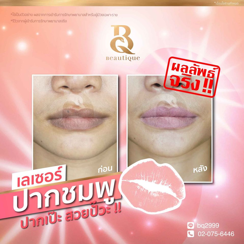 Beautique Aesthetic Center บริการเลเซอร์ปากชมพู - 2